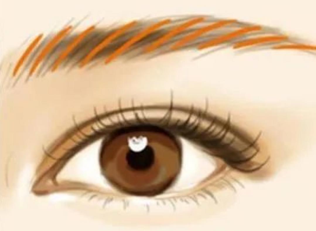 Le retrait du microblading laser (retrait du tatouage des sourcils) quittera-t-il des cicatrices?